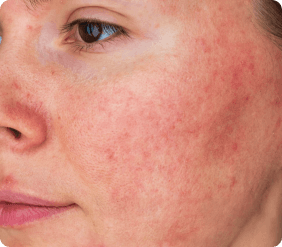 title.erythematous.pink