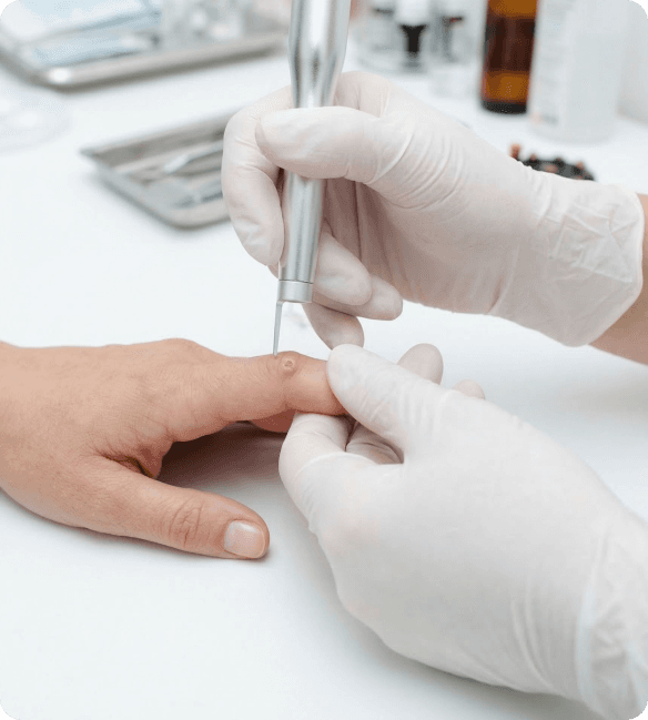 Jasne zdjęcie z bliska celowanego narzędzia dermatologicznego używanego przez lekarza do leczenia lub usuwania małych, zlokalizowanych zmian skórnych na powierzchni skóry pacjenta