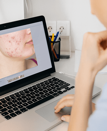 Doctor Reviewing Acne Case on Laptop Mobile Doctor Reviewing Acne Case on Laptop Mobile